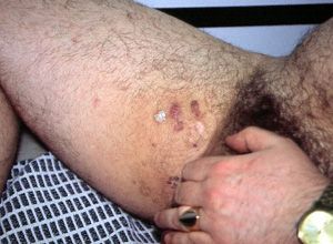 Диагностика и лечение кондилом у мужчин в Северо-Западном Центре лазерной медицины