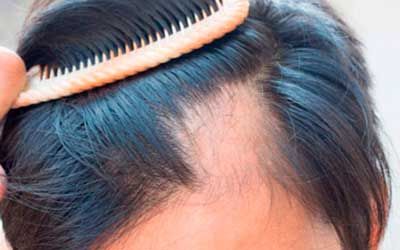 Как остановить выпадение волос народными средствами — Здоровье