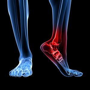 Артрит коленного сустава, пальцев ног и рук — лечение артрита