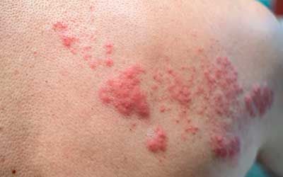 Инфекционные заболевания кожи