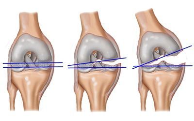 S83: Вывих, растяжение и перенапряжение капсульно-связочного аппарата коленного сустава