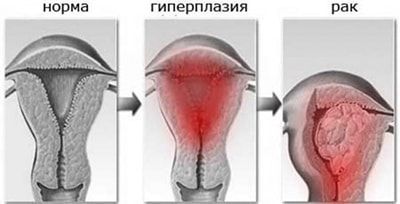 Лечение эндометриоза матки дюфастоном - Доктор Титов Денис Сергеевич