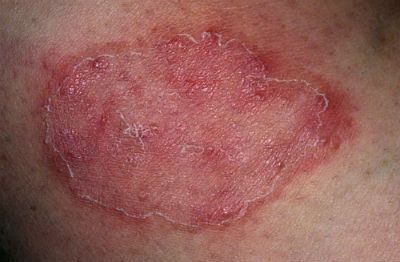Лечение грибковых инфекций кожи и ее придатков