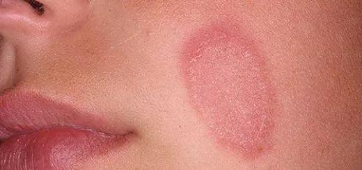 Лечение грибковых заболеваний на кожном покрове тела