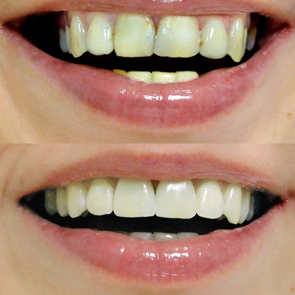 Как самостоятельно распознать кариес между зубами, чтобы своевременно записаться на лечение