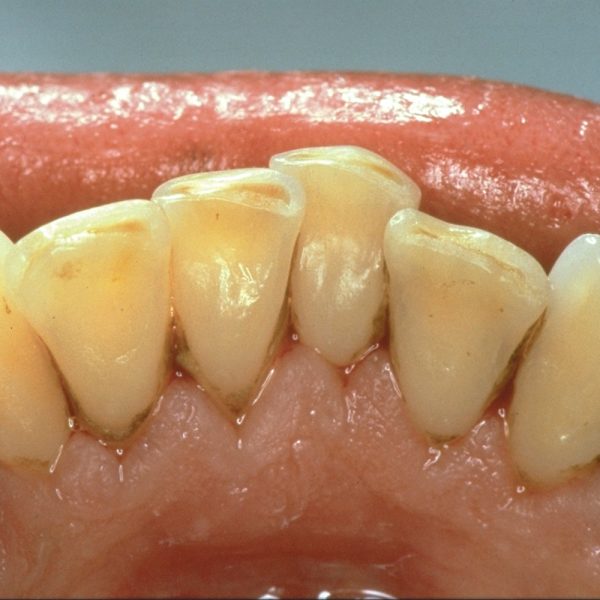 На передних молочных зубах кариес фото