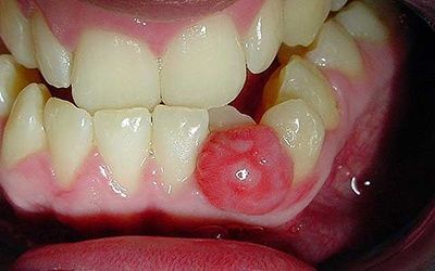Киста зуба: методы лечения, симптомы и цены