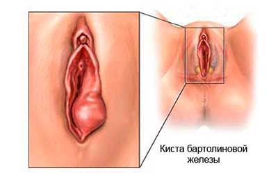 Пролапс матки и свода влагалища (апикальный вагинальный пролапс)