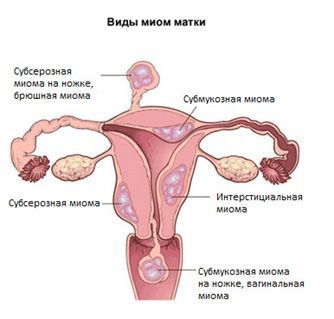 Центр лечения миомы матки