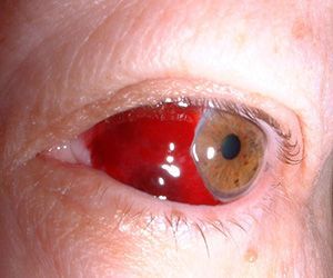 Чем лечить при кровоизлиянии в глаз