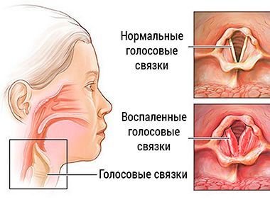 Как и чем лечить заболевания носа и горла?