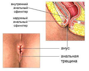 Растяжение анального отверстия для лечении спазма | КДС клиник в САО Москвы