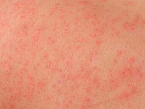 Аллергические реакции и кожная сыпь