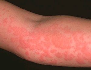 Виды кожной аллергии