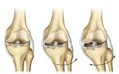 Как лечить повреждение связок коленного сустава?