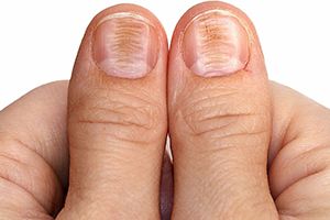 Как распознать симптомы грибка на пальцах рук