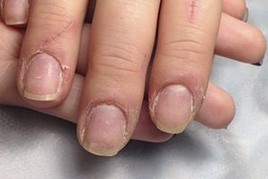 Грибок ногтей: симптомы и лечение