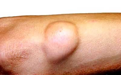 Опухоли мягких тканей