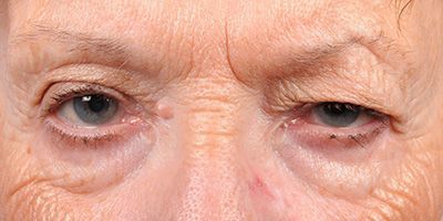 Устранение асимметрии глаз в косметологии