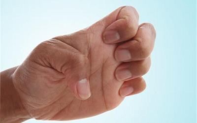 Остеоартроз кистей рук: симптомы, степени, лечение