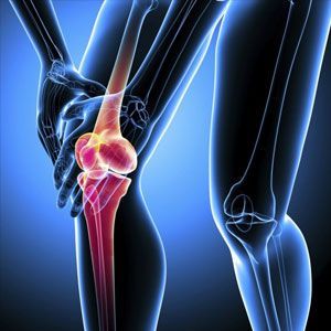 Артроз коленного сустава 2 степени – причины и лечение