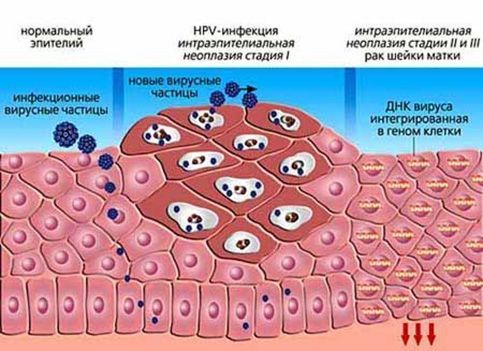 Методы лечения вируса папилломы человека у женщин и мужчин — клиника «Добробут»