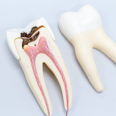 Почему появляется перфорация зуба