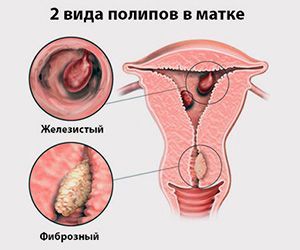полип матки можно вылечить без операции