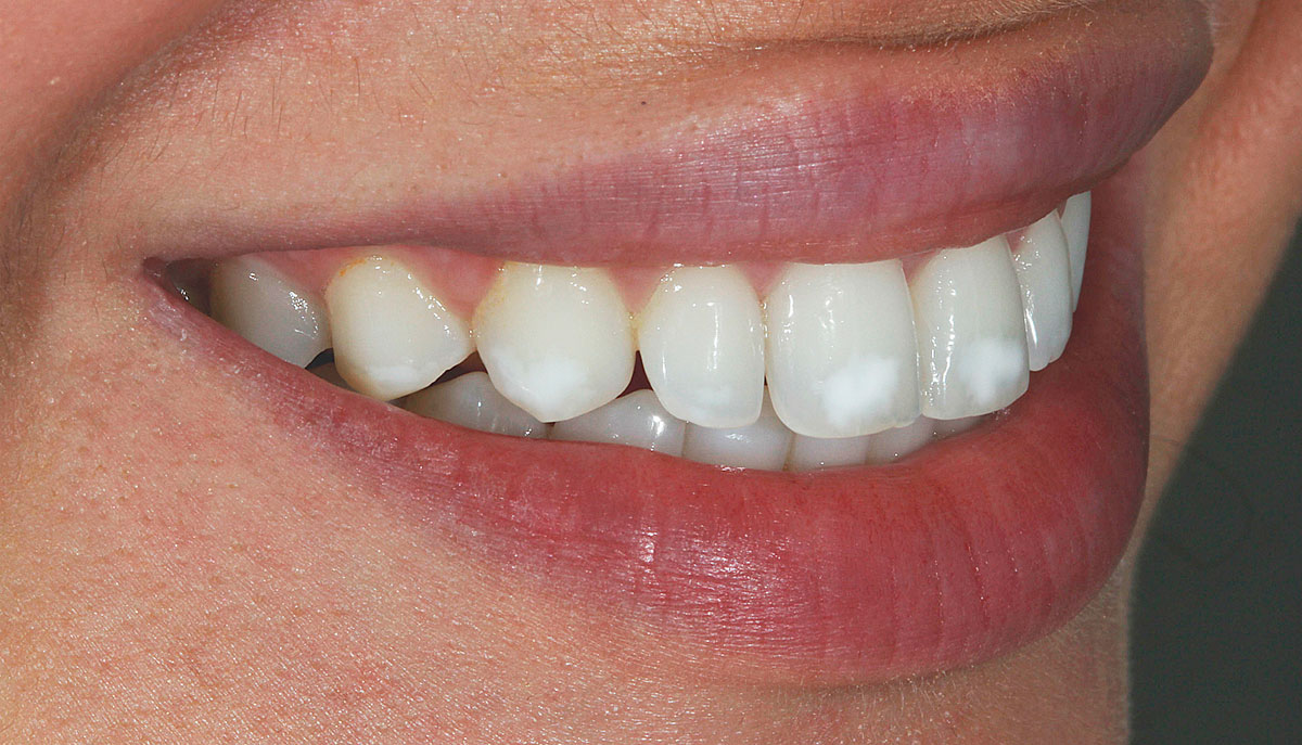 Почему возникают нарушения оттенка зубной эмали?