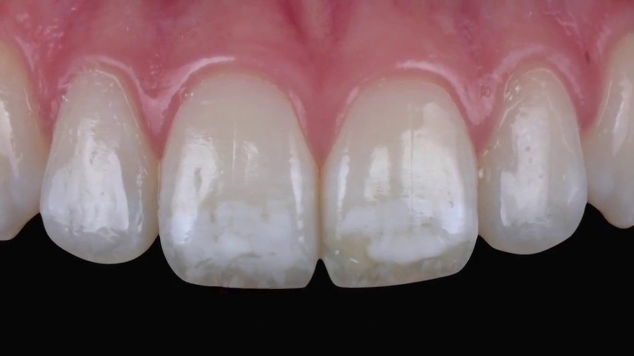 Пятна на зубах: откуда появляются и как устранить?
