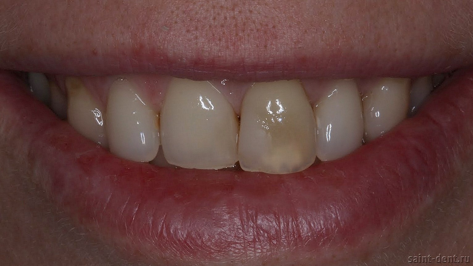 Пятна на зубах: белые, желтые, коричневые