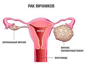 Как распознать рак матки?
