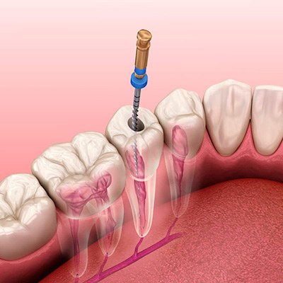 Лечение каналов зуба — этапы, фото, почему болит зуб после лечения каналов — Startsmile