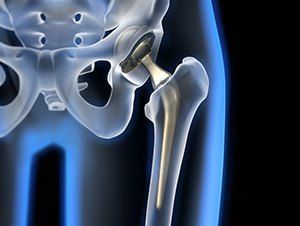 Что показывает рентген тазобедренного сустава у взрослых