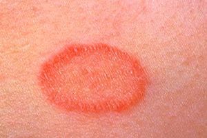 Лечение дерматита в паху