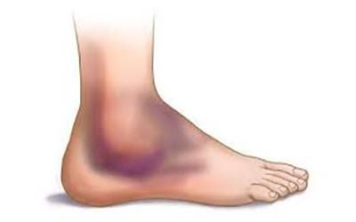 Какие причины воспаления сустава на ноге бывают?