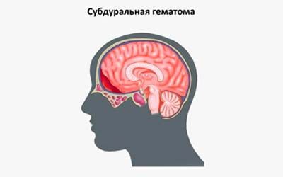 Ушиб мозга клиника лечение