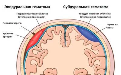 Ушиб головного мозга пластинчатая субдуральная гематома