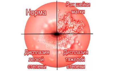 Лечение лейкоплакии наружных половых органов у женщин в Москве