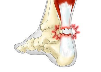 Пластика ахиллова сухожилия (I категория сложности) в клинике ЦЭЛТ в Москве