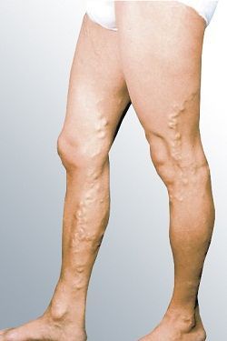 Лечение варикоза вен в клинике ЦЭЛТ в Москве