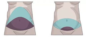 Миниабдоминопластики  в клинике ЦЭЛТ в Москве