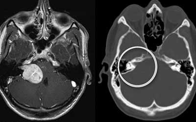 Опухоли неврилеммома
