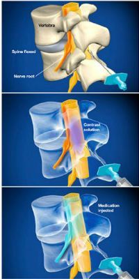 Эпидуральная блокада позвоночника в клинике ЦЭЛТ в Москве
