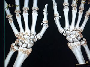 Компьютерная томография лучезапястного сустава в клинике ЦЭЛТ в Москве