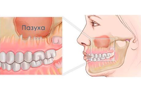 Операция верхнечелюстной пазухи в клинике ЦЭЛТ в Москве
