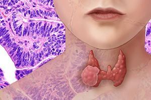 Аденома паращитовидной железы