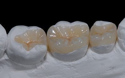 Керамические вкладки в клинике ЦЭЛТ в Москве