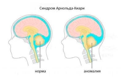 Аномалия Арнольда-Киари