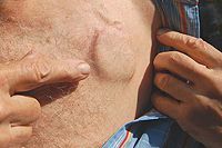 Операция по установке кардиостимулятора в клинике ЦЭЛТ в Москве